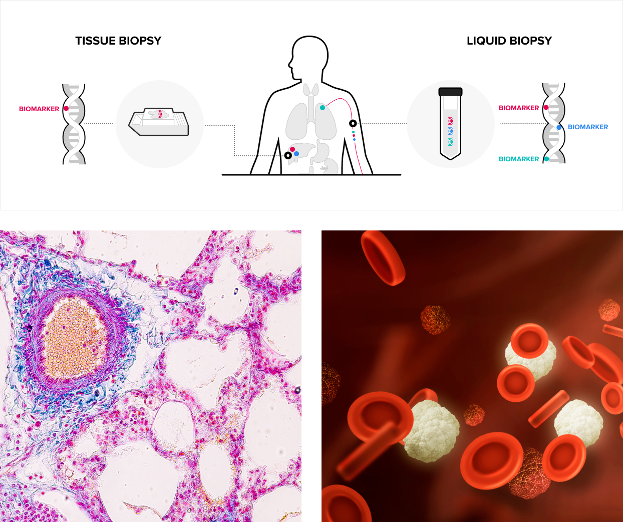 Tissue biopsy / Liquid biopsy